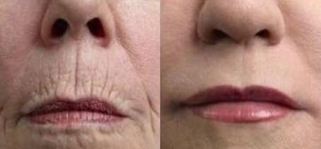 嘴角下垂,此类人群的口轮匝肌一般都比较发达,可以通过注射肉毒素抑制