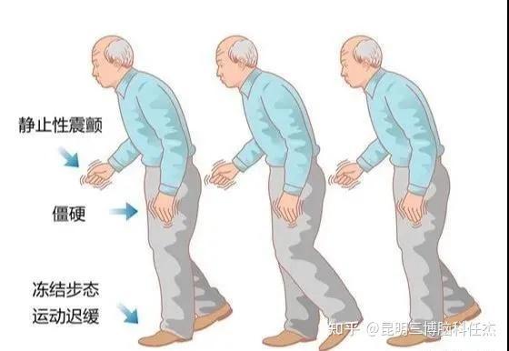 帕金森病如何治疗最有效?了解帕金森,知“帕”才不怕! - 知乎