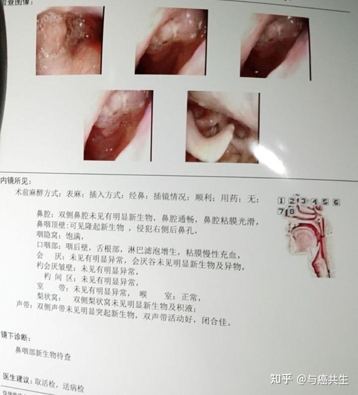 我是怎么发现自己得了鼻咽癌 - 知乎