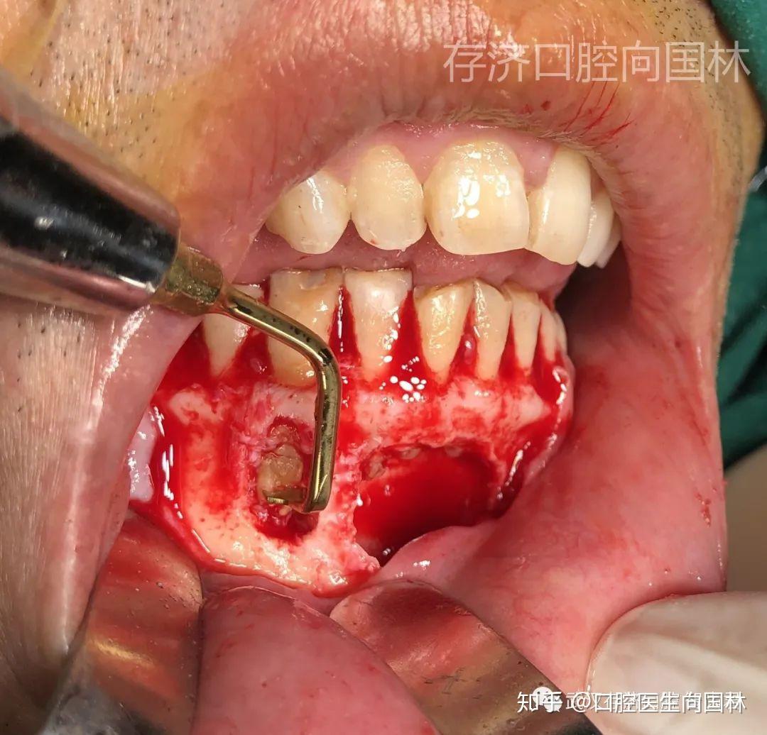 典型案例超声骨刀下颌骨囊肿摘除根尖切除根管倒充填术