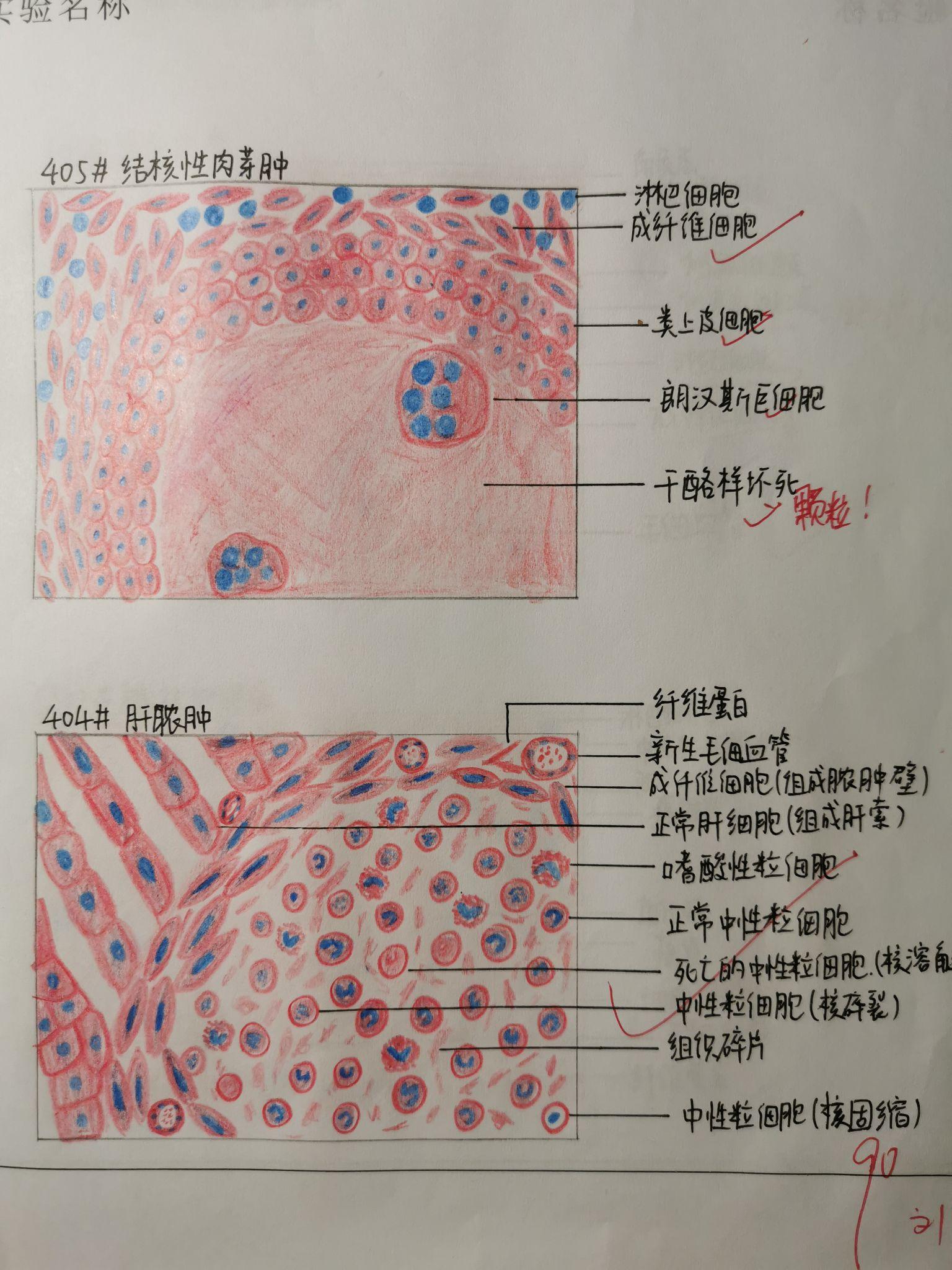 肝脓肿红蓝铅笔手绘图图片