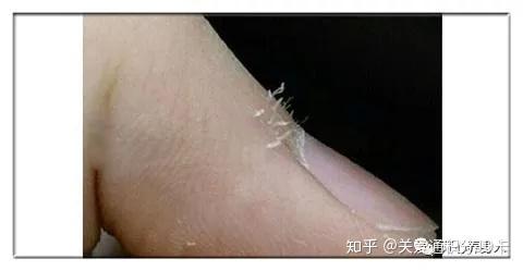 手指上的倒刺千万别乱撕,乱撕后果很严重 - 知乎
