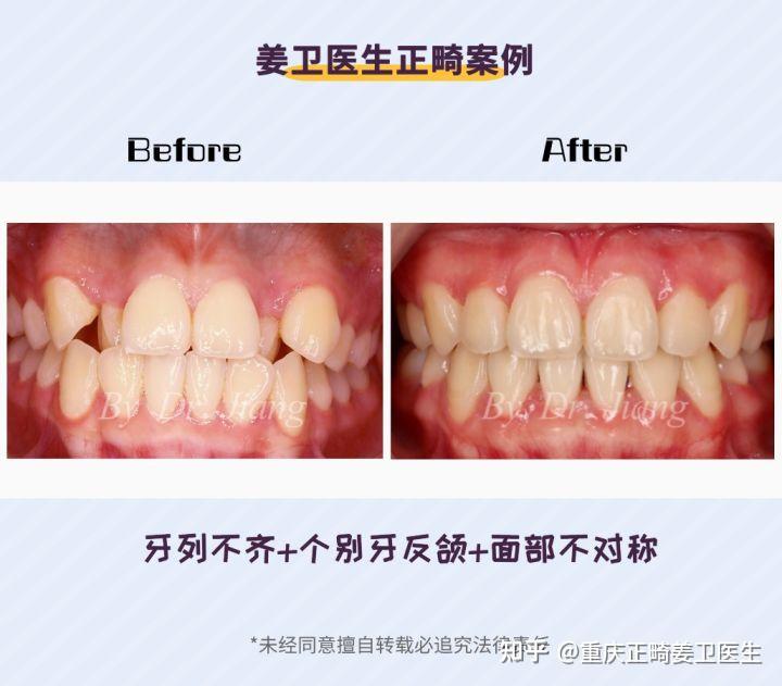 重庆牙齿矫正|提高成功率!超详细的正畸前、中、后注意事项 - 知乎