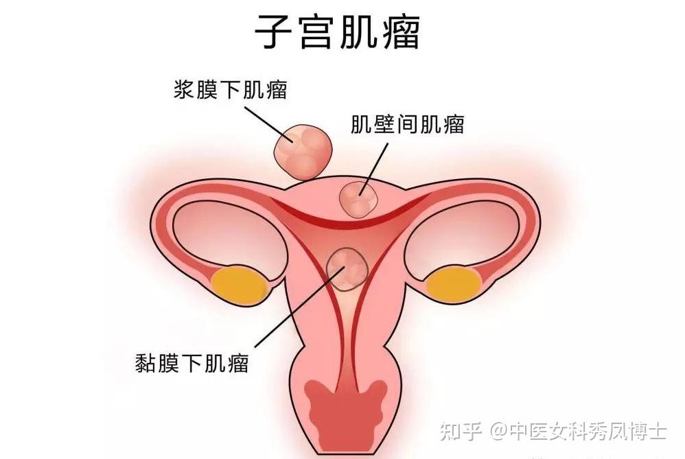 月經不調與子宮肌瘤極為密切,月經的變化也反應了肌瘤的變化.