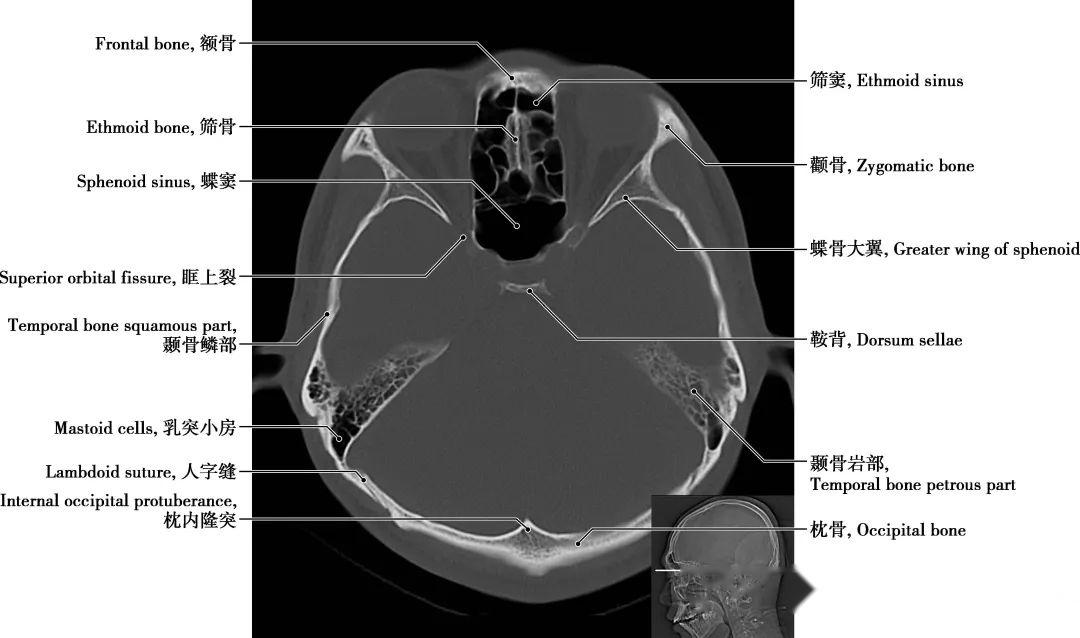 详细标注版!颅脑CT正常解剖图谱 - 知乎