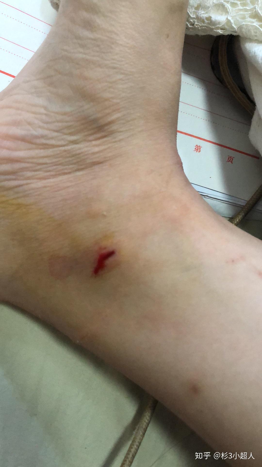 崴脚记录 - 知乎