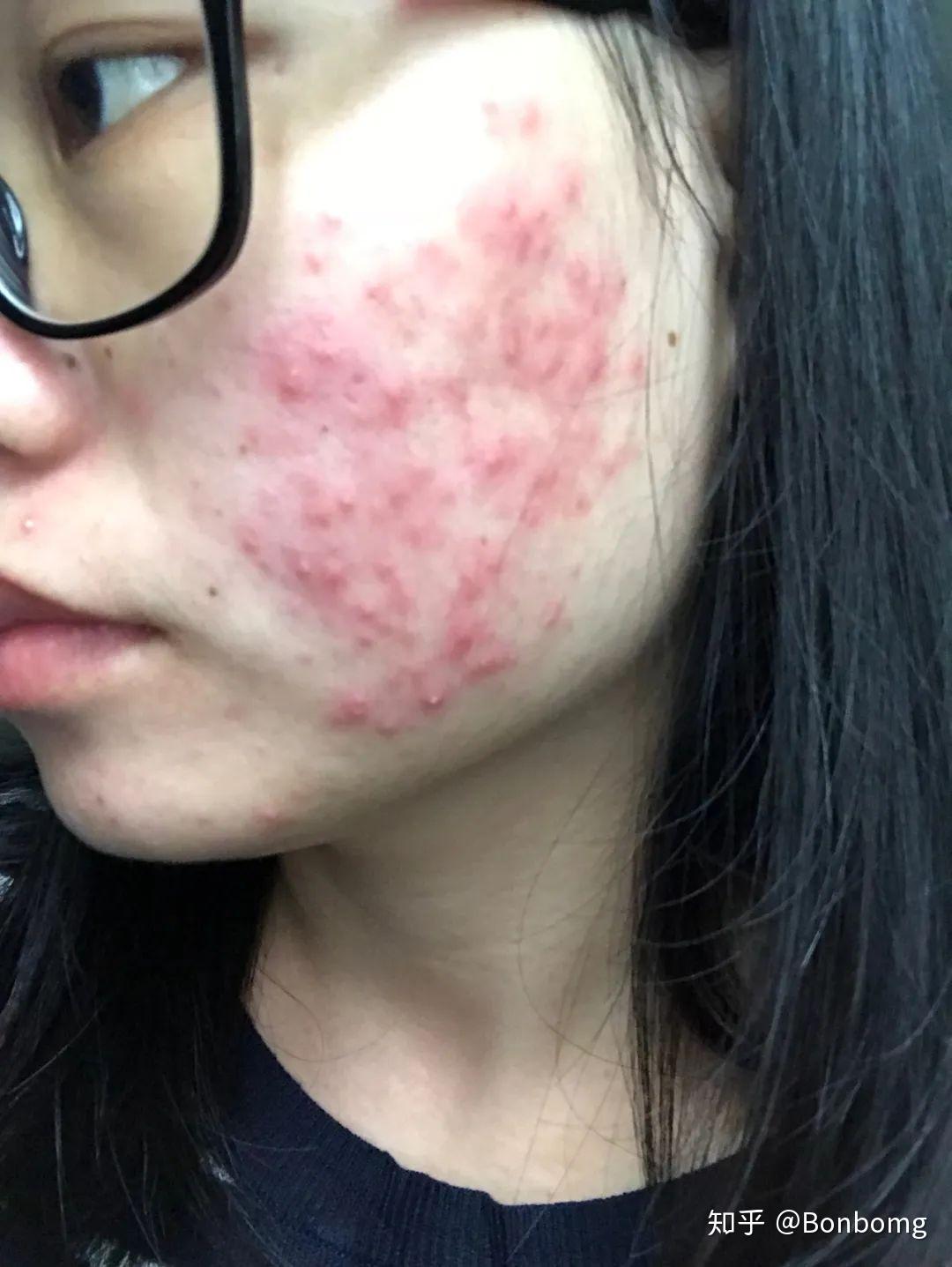 我的激素依赖性皮炎爆发及治愈过程实战