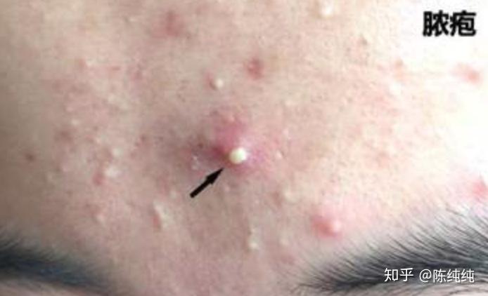 粉刺脓包痘痘怎么治 v2-bb64a34aa2f184edd21638129439bcc2_r.jpg
