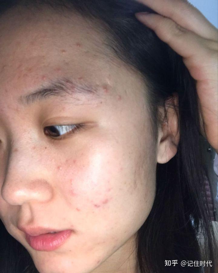 本人女!经常满脸爆痘,2个月自律祛痘分享(囊肿痤疮青春痘请进)