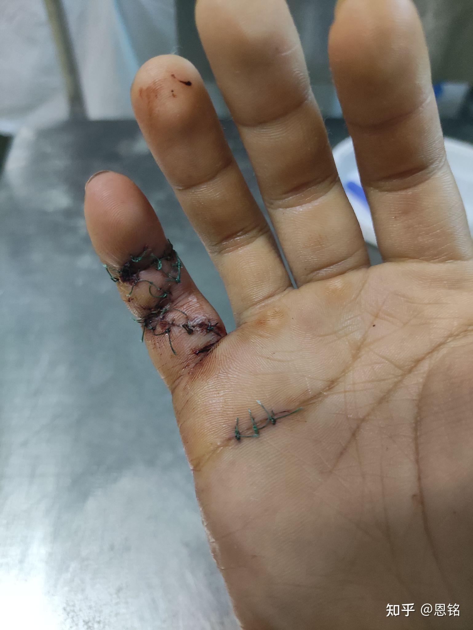 手指肌腱断裂最后一节无法伸直医生教我不要治疗了请