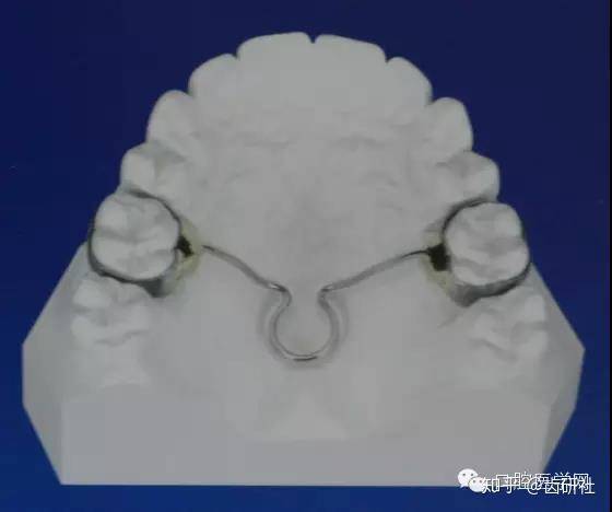 牙齿矫正知识科普帖:正畸牙套装置部件详解(附图片) - 知乎