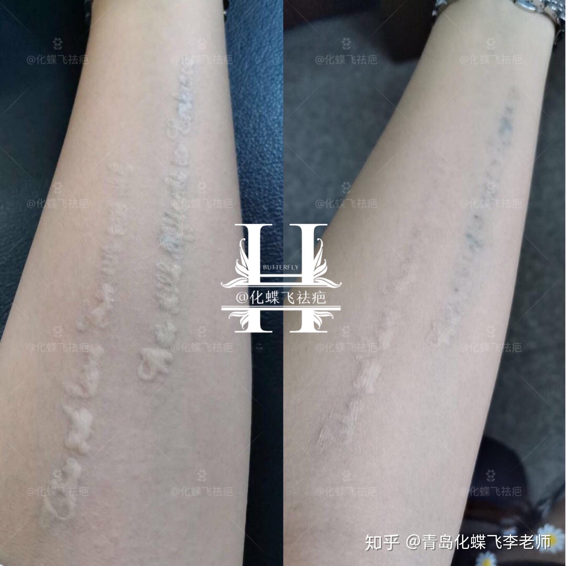 洗纹身能洗伤疤吗 v2-bb84acd94cda3d97b4023ff0a5aafc5e_r.jpg