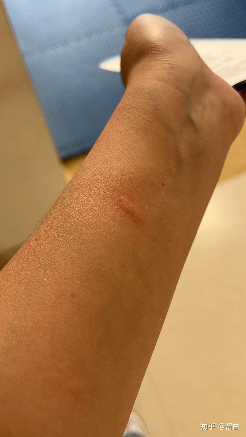 记录脱敏治疗(过敏性鼻炎 粉尘螨极强阳性)