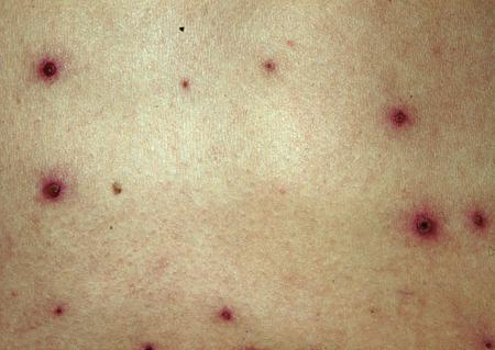 eb病毒感染皮肤图片图片