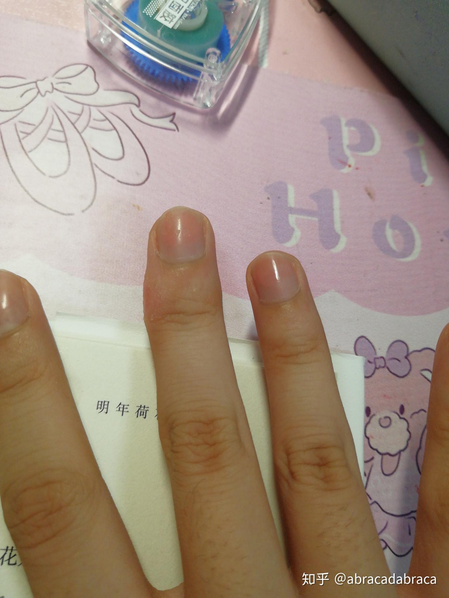 因为写字手指长得茧怎么消下去