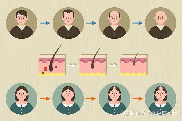 毛发科普|雄秃的原因?如何判断雄秃?雄秃怎么办? - 知乎