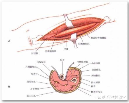 图文详解尺骨入路