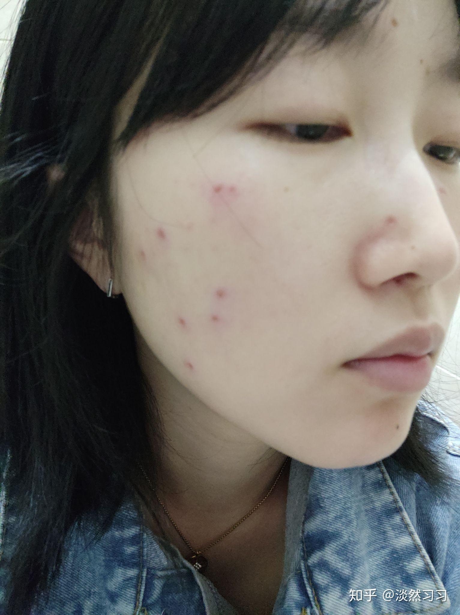 激光点痣分享 - 知乎