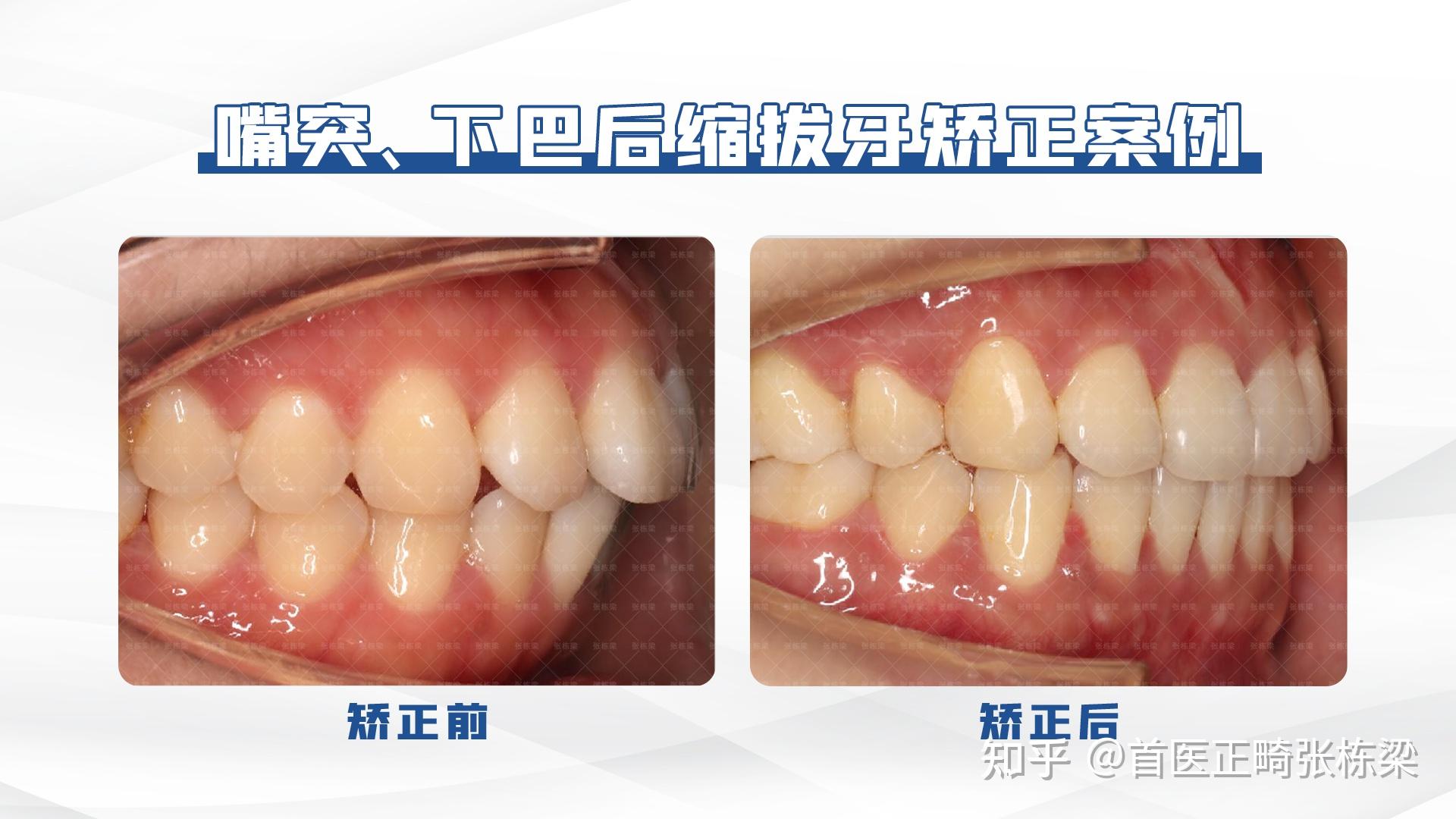 牙齿矫正案例：双颌前突，改善嘴突 - 知乎