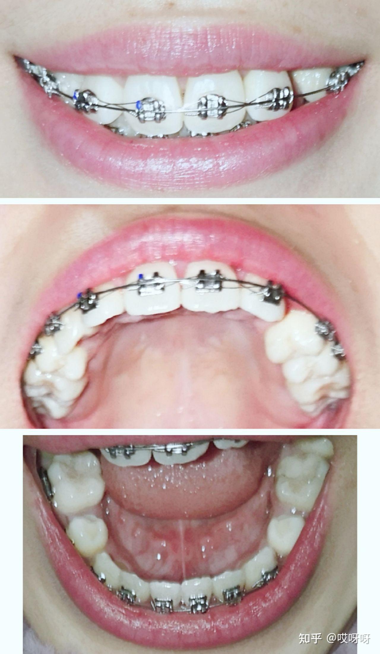 正畸分享虎牙埋伏牙