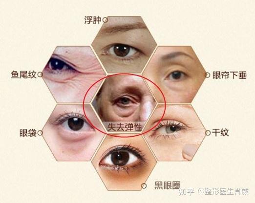 黑眼圈可以通过注射肉毒素进行改善2,动态的眉间纹,鱼尾纹可以解决上