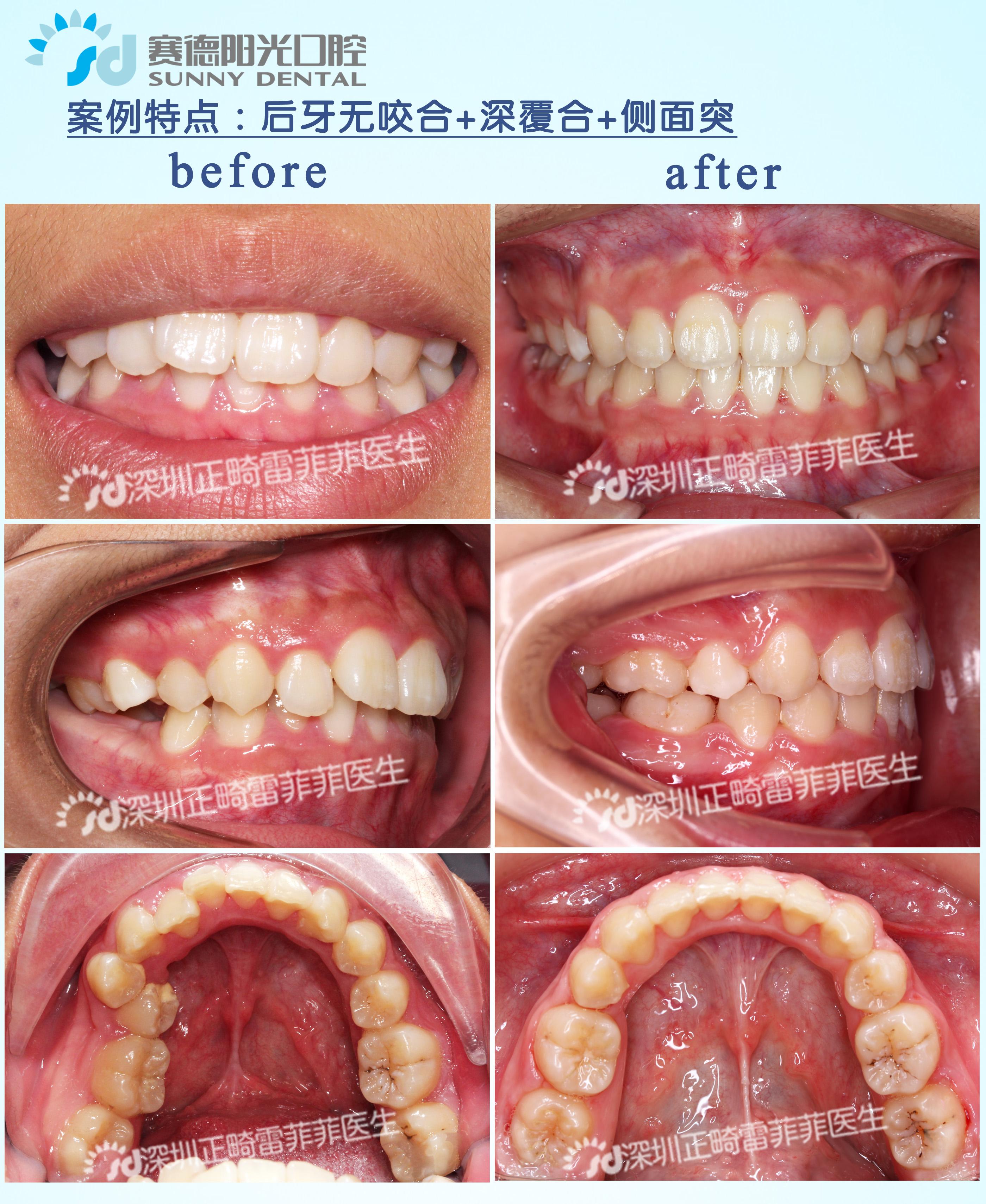 正畸病例集（一） 知乎