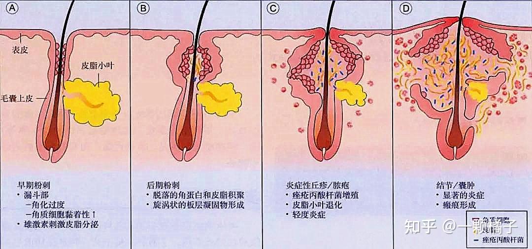 一,认识自己的痘(又名痤疮)