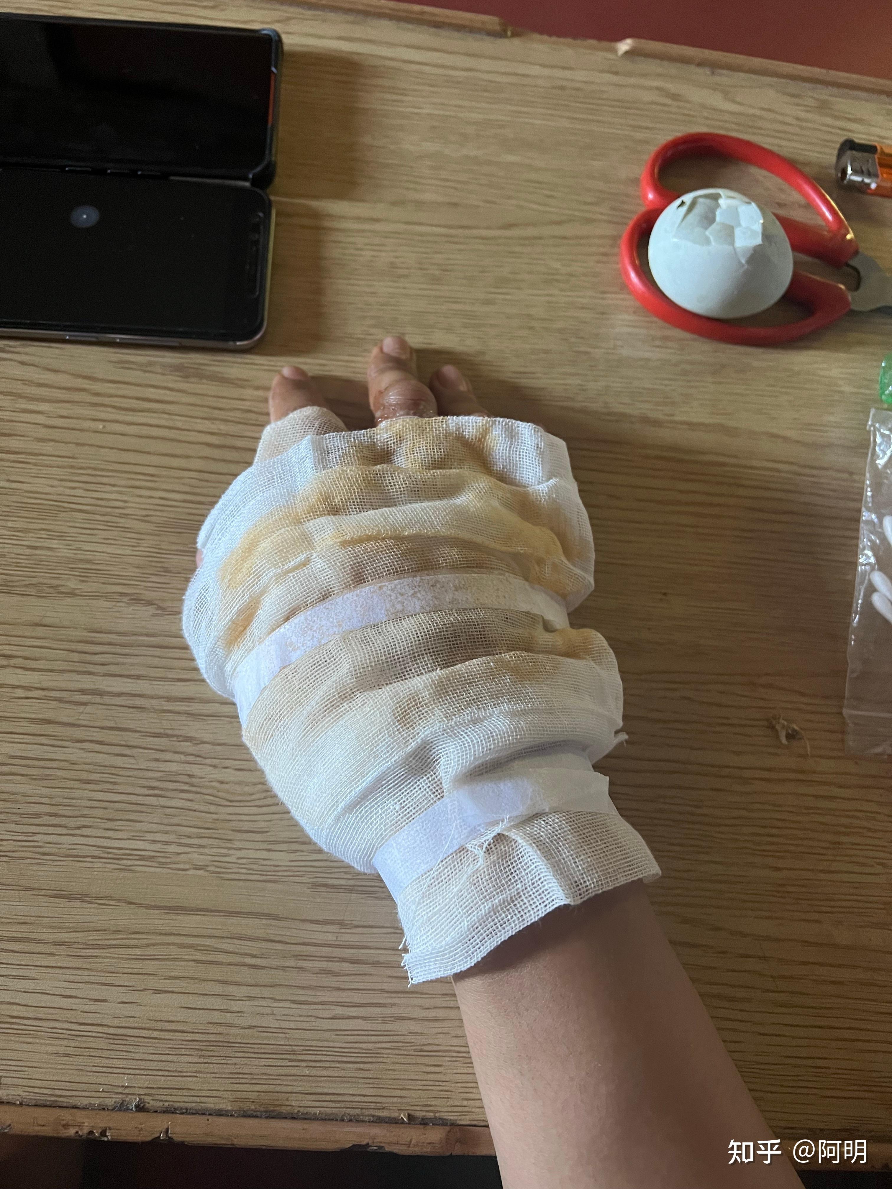 手背浅二度烫伤恢复过程记 - 知乎