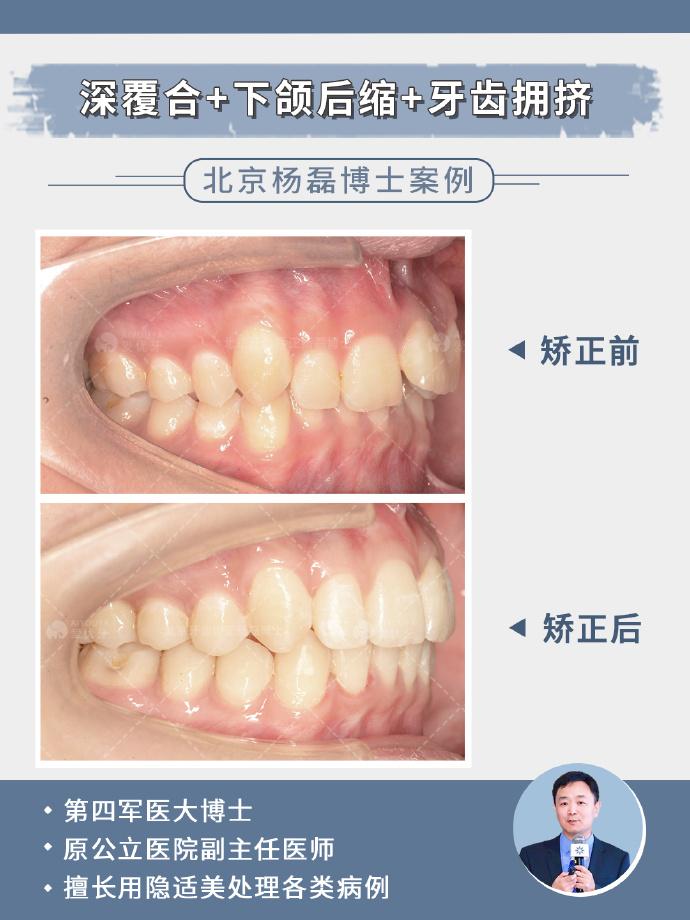 下颌联冠斜导图片图片