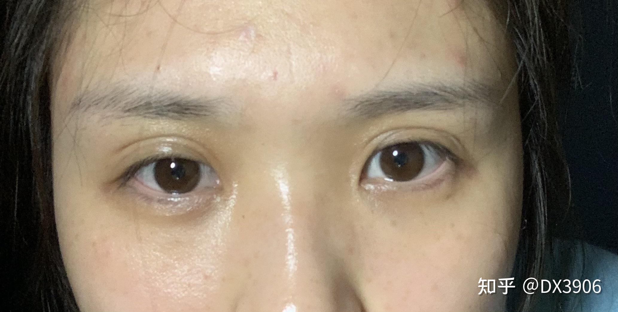 天生眼窝凹陷,做了全切双眼皮.术后六个月出现三眼皮.