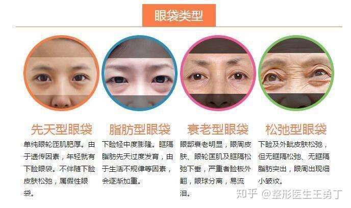 眼袋有几种呢