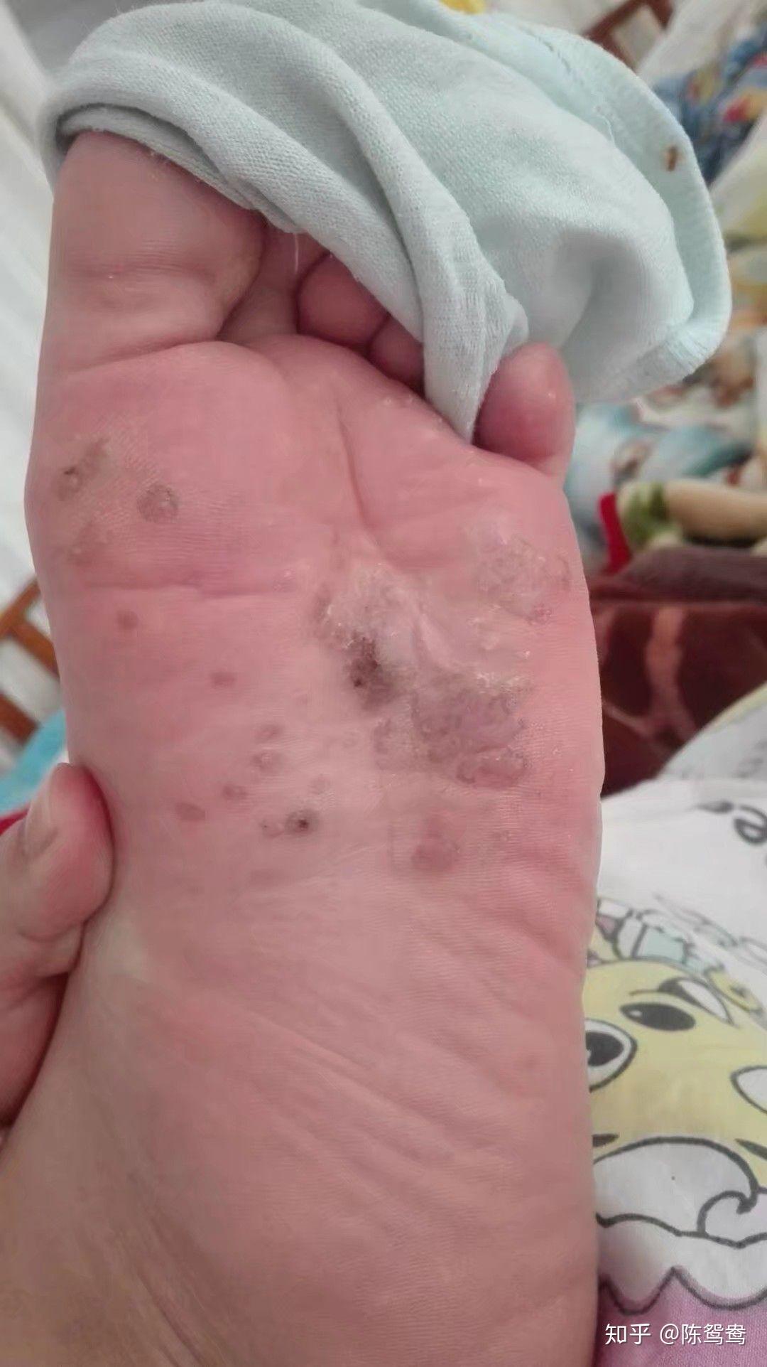 (泡了半小时的鬼样子,非常可恨的厚脚皮,恨不得用指甲剪给他剪深一点)