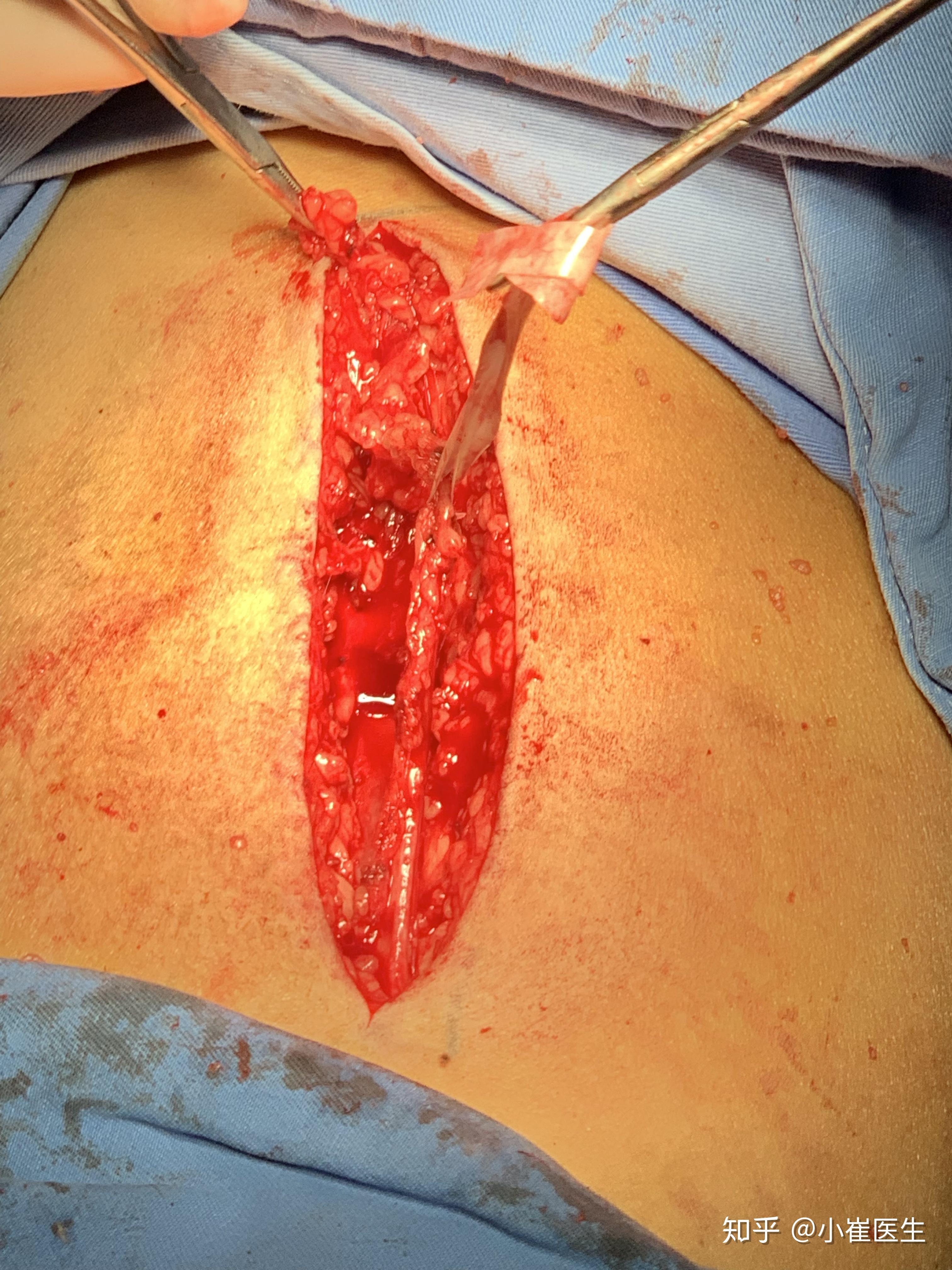 自体大隐静脉移植重建静脉流出道—病例分享