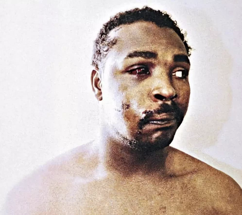 罗德尼·金的右眼窝被殴打至粉碎，身上还有电击留下的伤痕