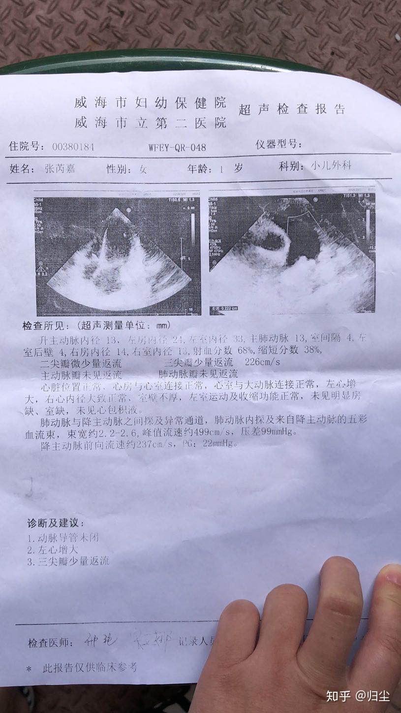 一岁宝宝动脉导管未闭,左心增大 - 知乎