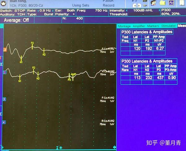 电生理的检查:上肢体感诱发电和脑干听觉诱发还是不错的.