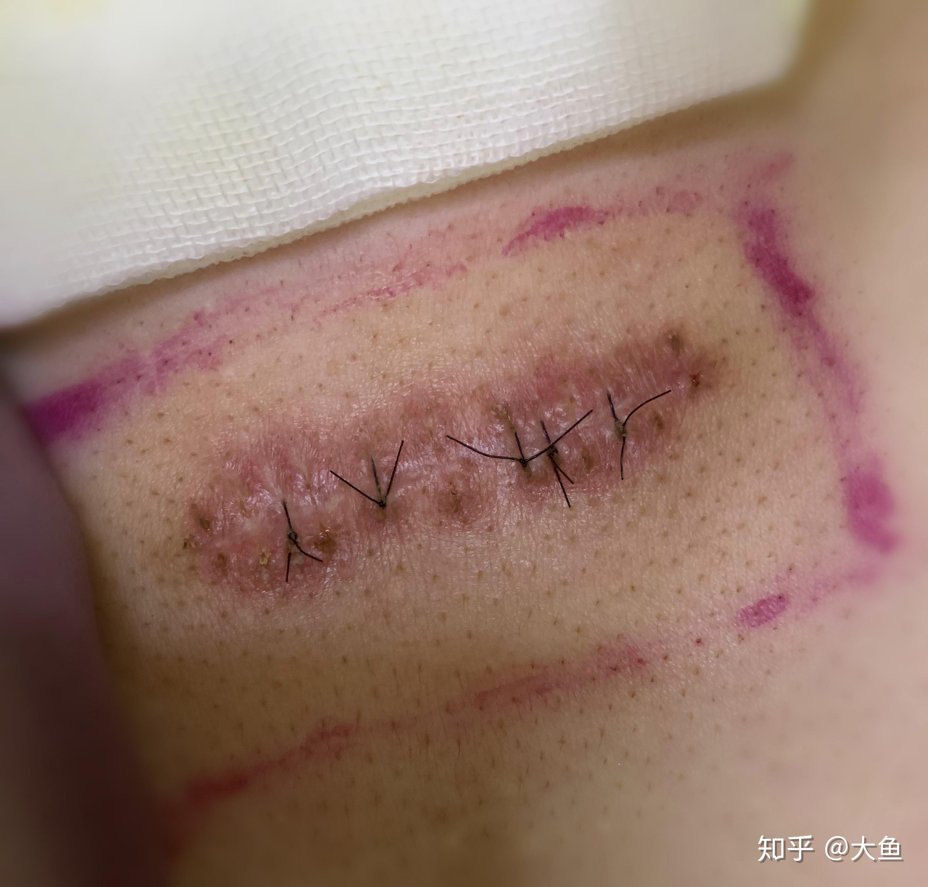 胸前手术伤口疤痕图片图片