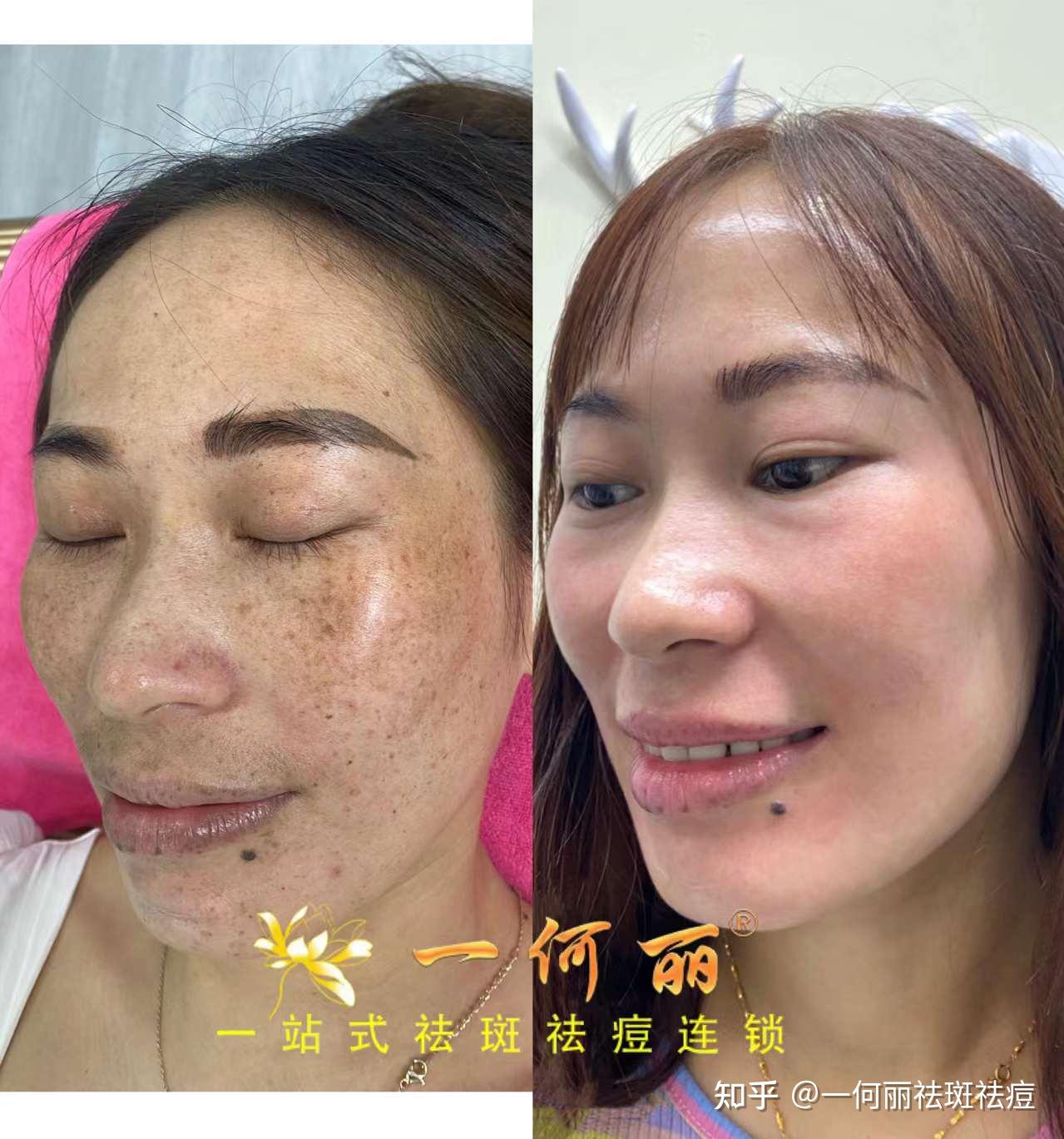 又双叒叕拯救了一张脸,从满脸麻子到发光发亮,四个月就可以做到 - 知乎