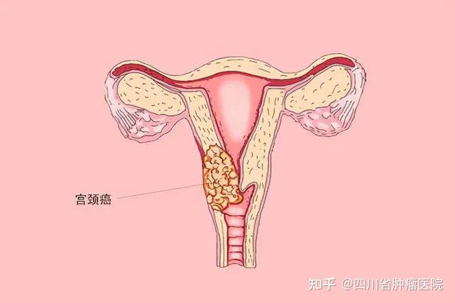 子宫颈癌是指发生在女性子宫颈部位的恶性肿瘤,可以向周围组织,器官