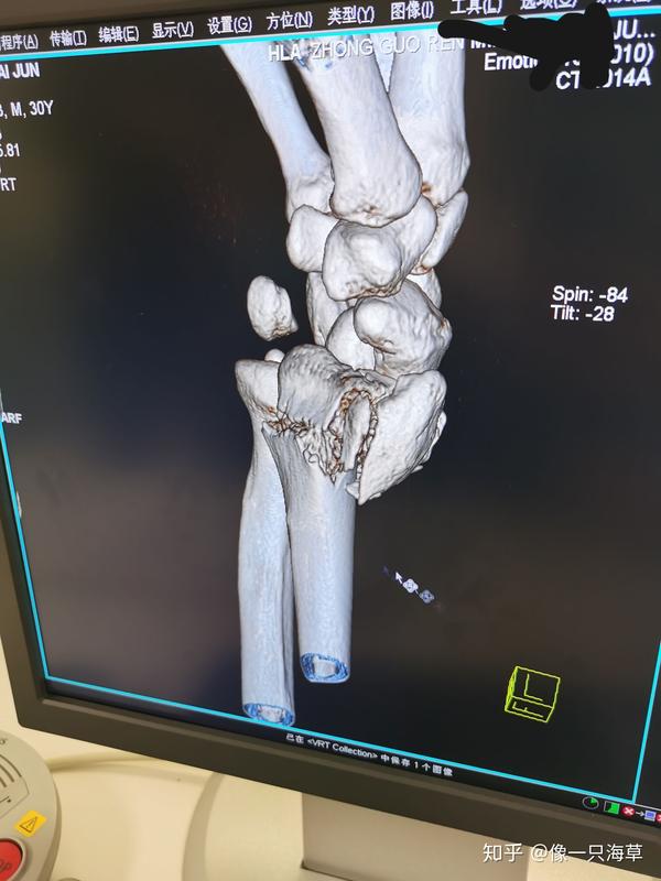 右臂桡骨骨折之旅 艰难康复中 右手桡骨骨折康复期 德涵网