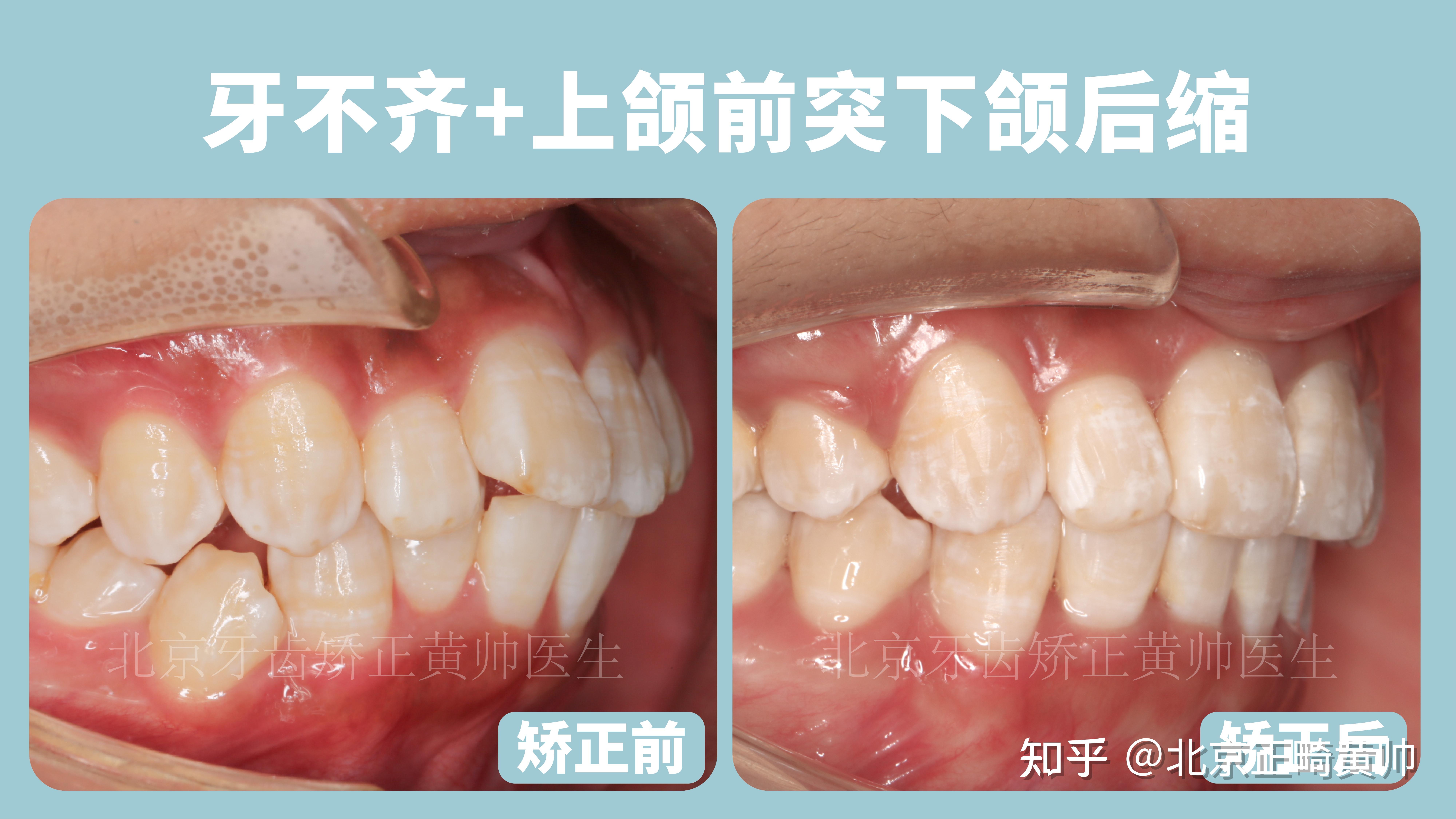 牙齿正常倾斜角度图图片