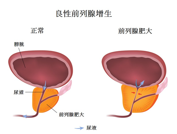 经尿道前列腺电切术有哪些常见并发症 知乎