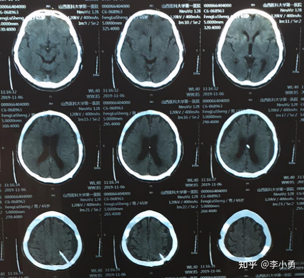 能控制不倒翁样起床动作在李小勇脑脊液科艰难治疗后乐享健康晚年生活