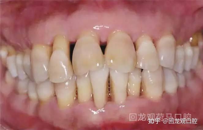 严重的牙周炎常有明显的病理性牙移位或松动,但牙齿矫正同时也是在