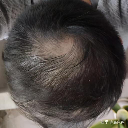 男性头秃植发(男性脱发植发后还会脱吗)
