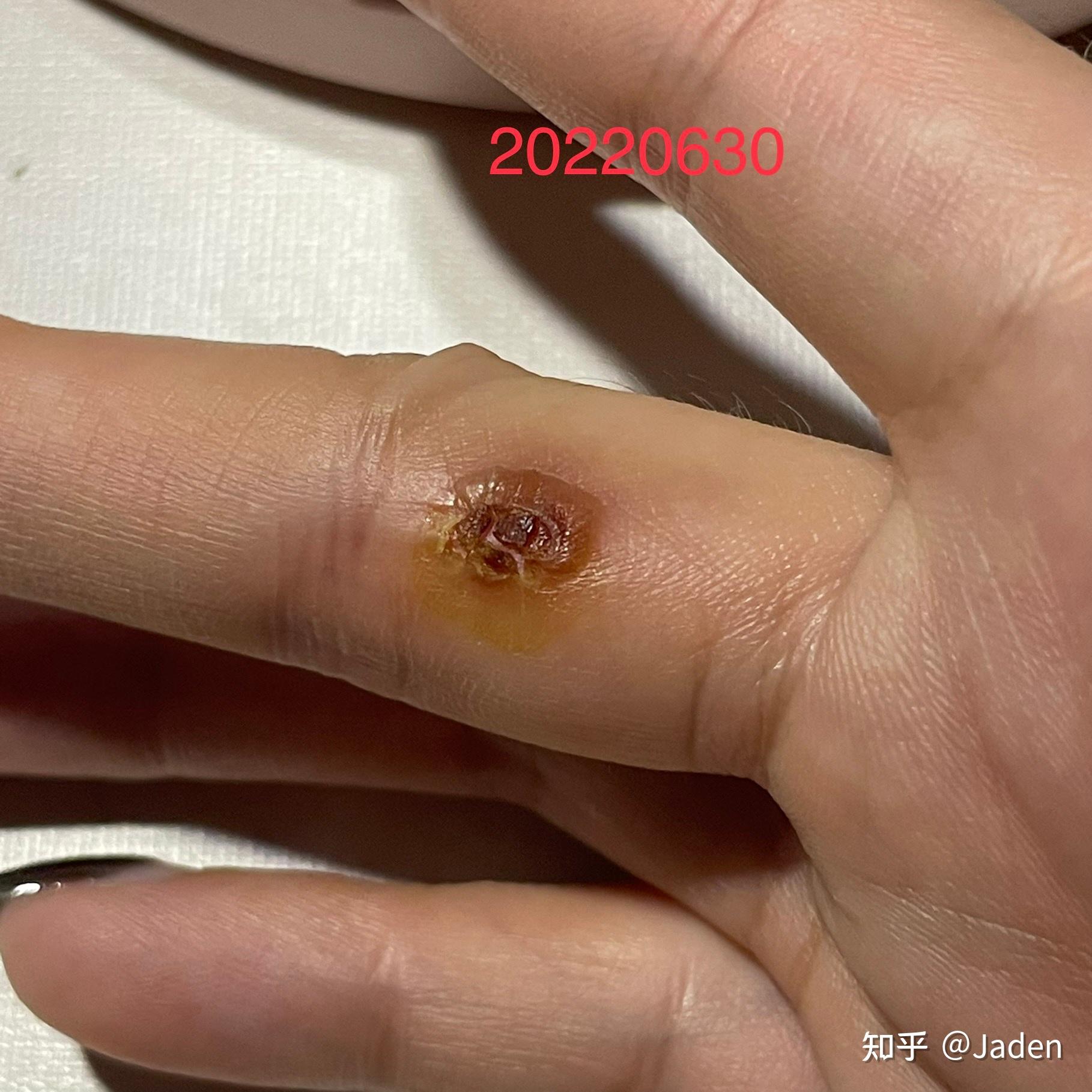 鸦胆子去除寻常疣经历分享