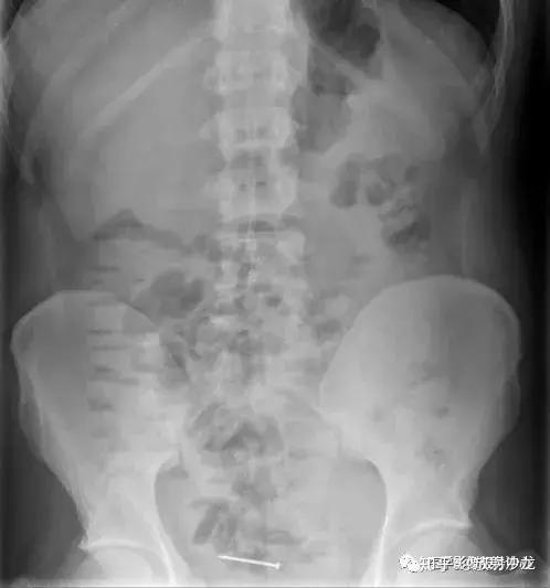 吞入体内的异物多久能排出?X线告诉你真相 - 知乎