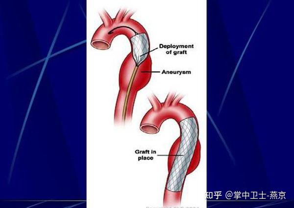 主動脈夾層支架術後為啥會吐血哪些情況會發生消化道出血