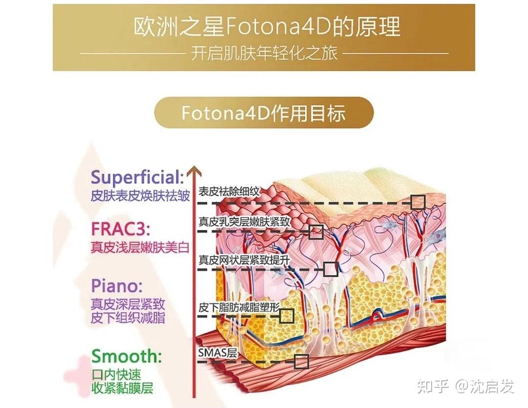 欧洲之星fotona4dpro干货原理效果