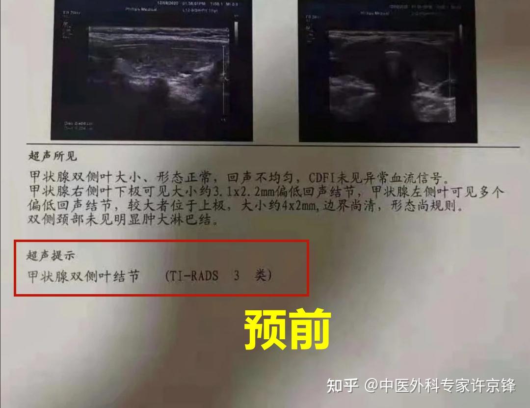 病例分享女出租车司机患上甲状腺3类结节背后原因值得深思